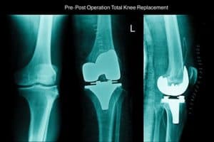 Knee Replacement Lawyers