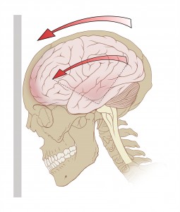 Traumatic Brain Injuries