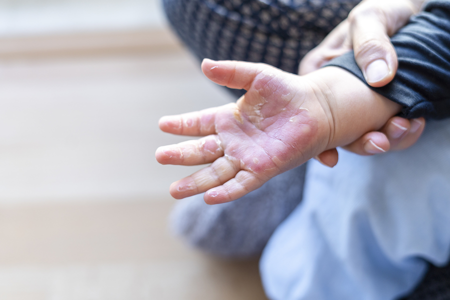 Close up of burned hand of small child